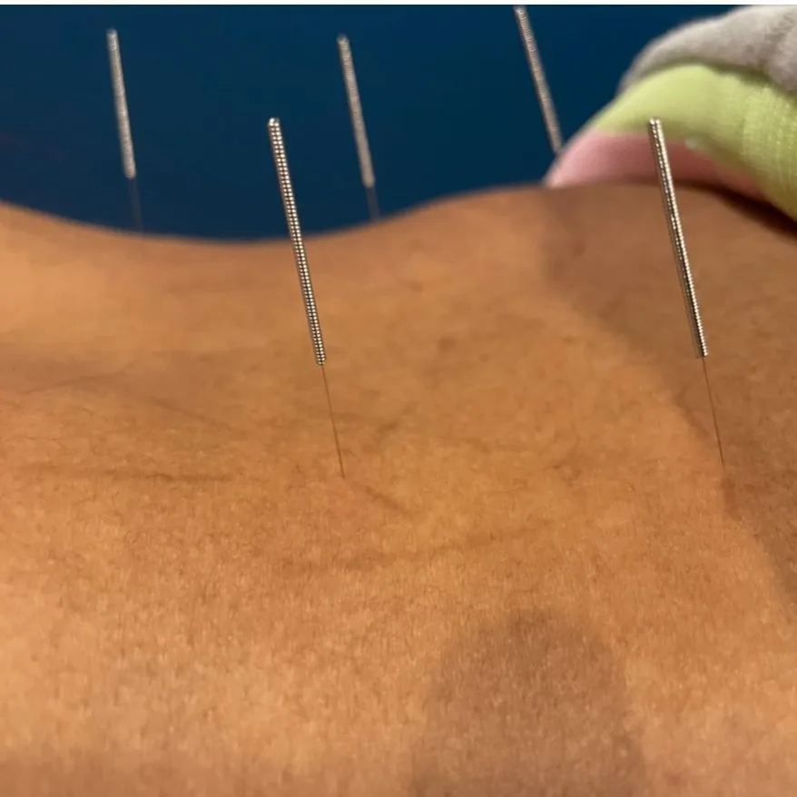 Tratamiento de acupuntura con agujas finas en Juarez Chiropractic en Chicago
